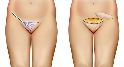 Cirugía íntima femenina Cirugía íntima femenina