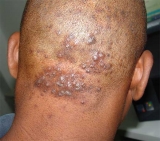  Acn� queloideo de la nuca