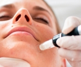 Microneedling: la mesoterapia que abre m�s de 1.000 microcanales por segundo