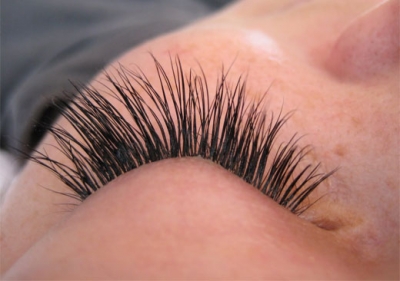 Hipotricosis de las pesta�as: tratamiento con bimatoprost